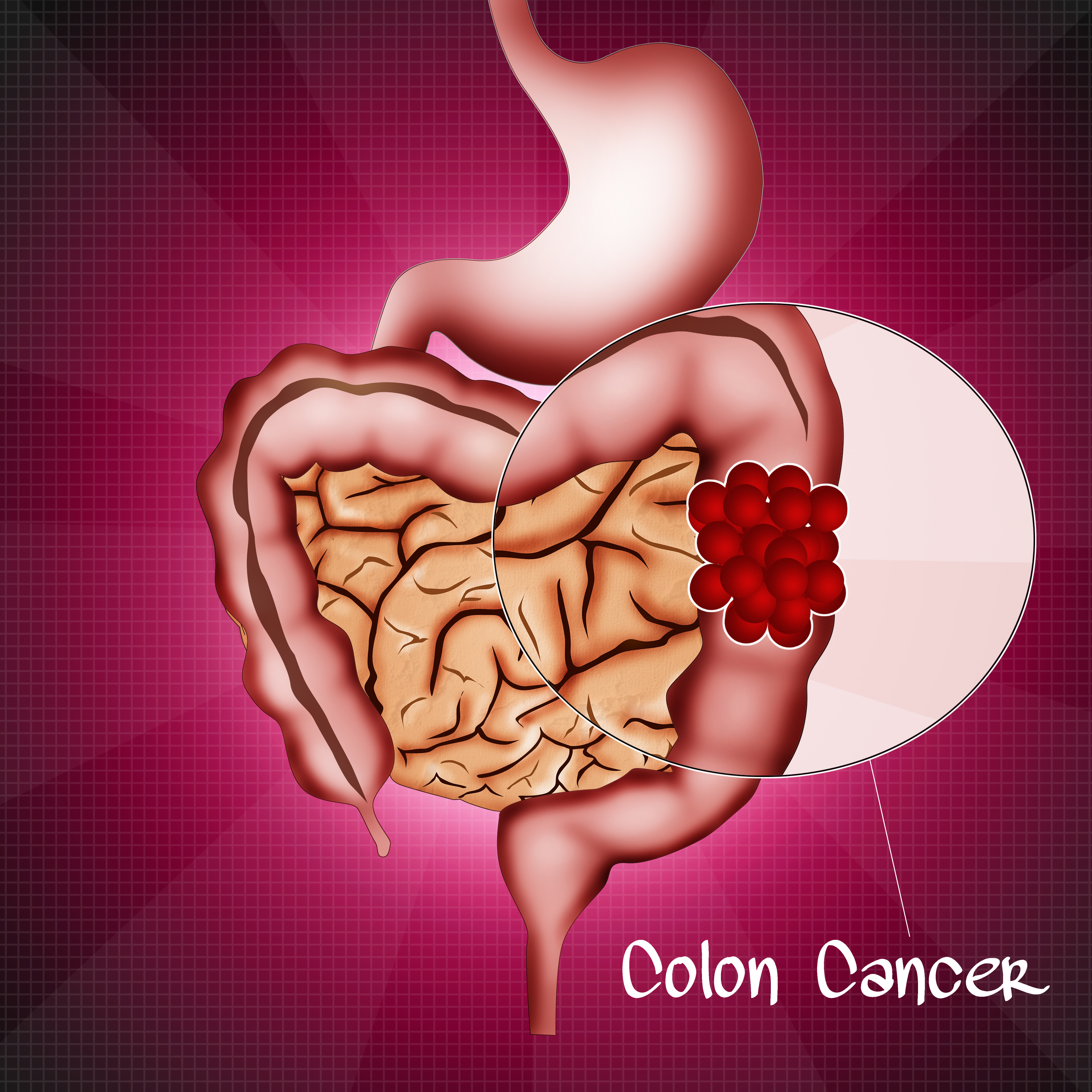 Colon cancer in older adults